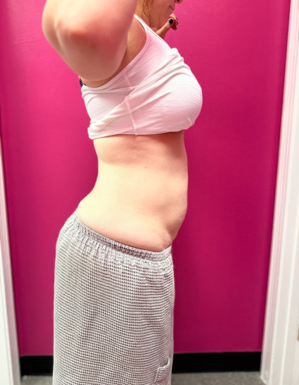 Client after nine body sculpting sessions