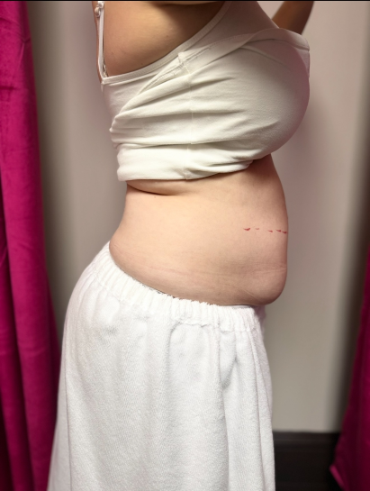 Client before nine body sculpting sessions