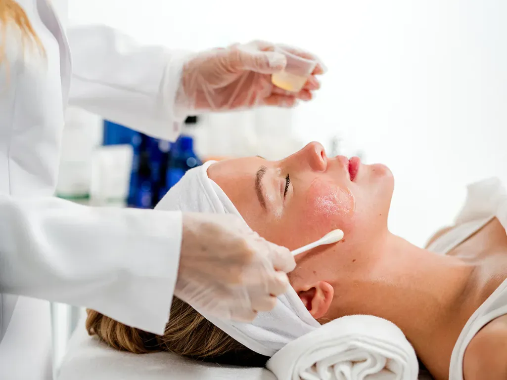 Chemical peel treatment