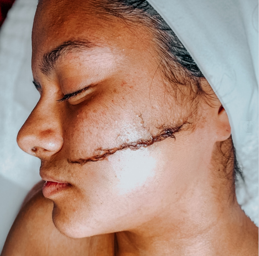 Dermaplaning treatment